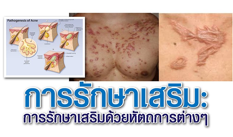 การรักษาเสริม: การรักษาเสริมด้วยหัตถการต่างๆ การรักษาเสริม: การรักษาเสริมด้วยหัตถการต่างๆ